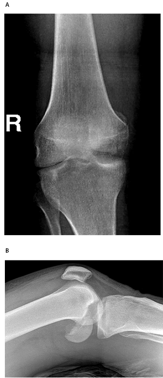 Femoral Condyle Fracture Figure 1