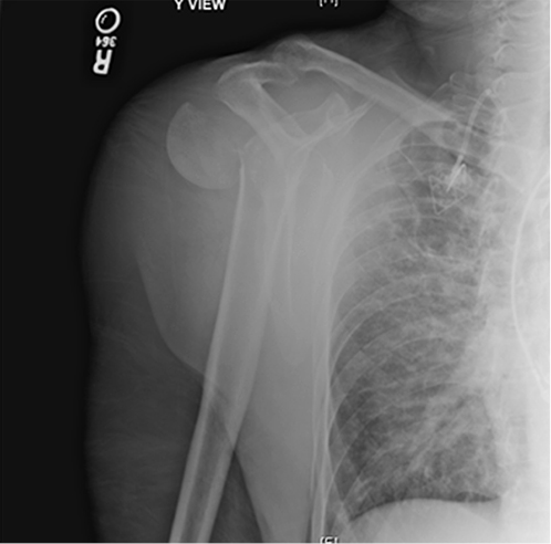 Bilateral Posterior Shoulder Fracture Dislocations Figure 1