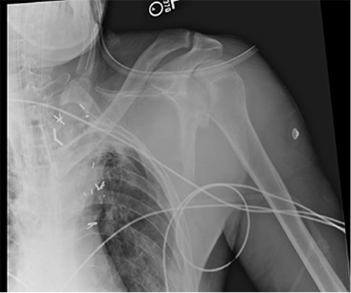 Bilateral Posterior Shoulder Fracture Dislocations Figure 2