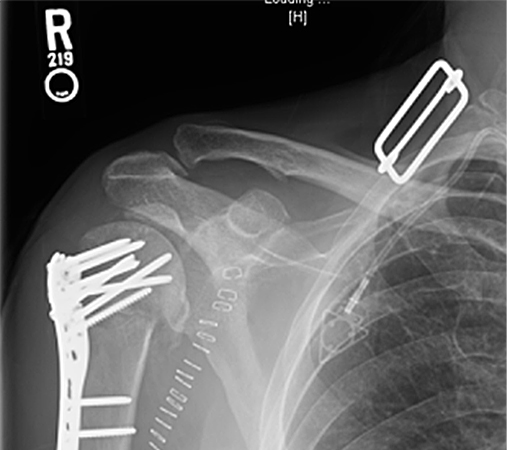 Bilateral Posterior Shoulder Fracture Dislocations Figure 3