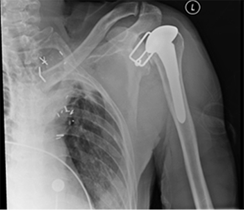 Bilateral Posterior Shoulder Fracture Dislocations Figure 4