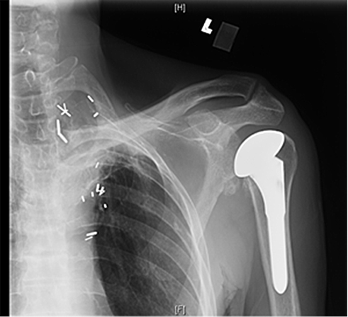 Bilateral Posterior Shoulder Fracture Dislocations Figure 5