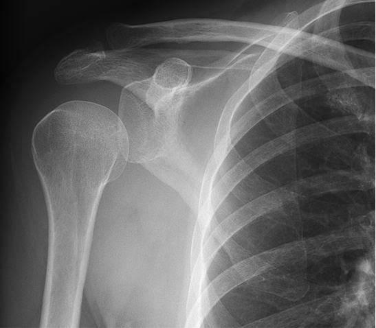 Septic Arthritis Figure 1