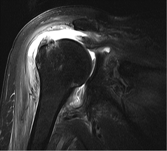 Septic Arthritis Figure 2