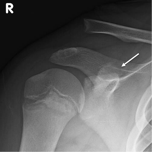 Acromioclavicular 'Pseudo-dislocation' with Concomitant Coracoid