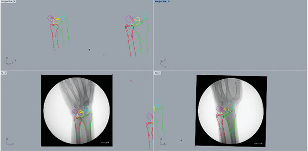 3D CT Wrist Figure 4