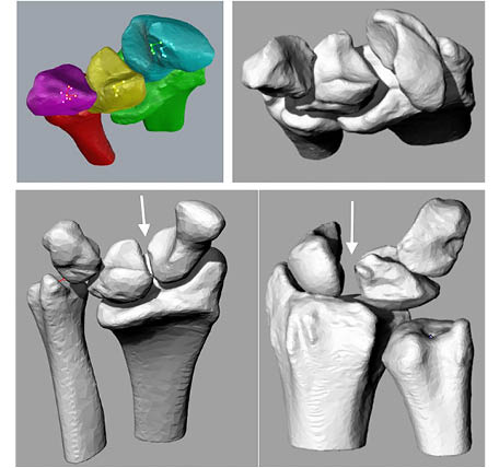 3D CT Wrist Figure 8