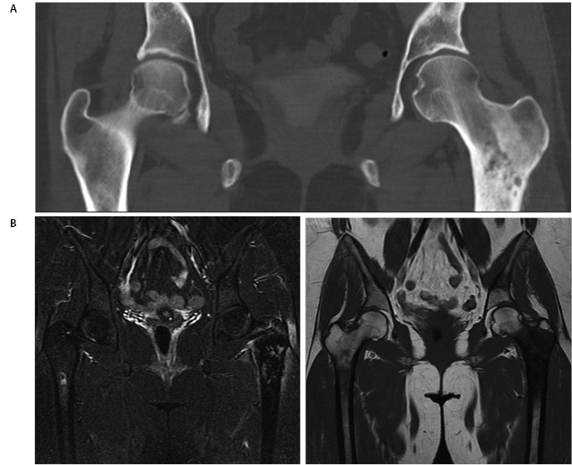 Radiation Sarcoma Figure 1