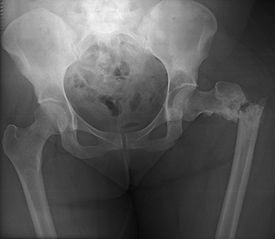 Radiation Sarcoma Figure 2