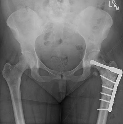 Radiation Sarcoma Figure 3