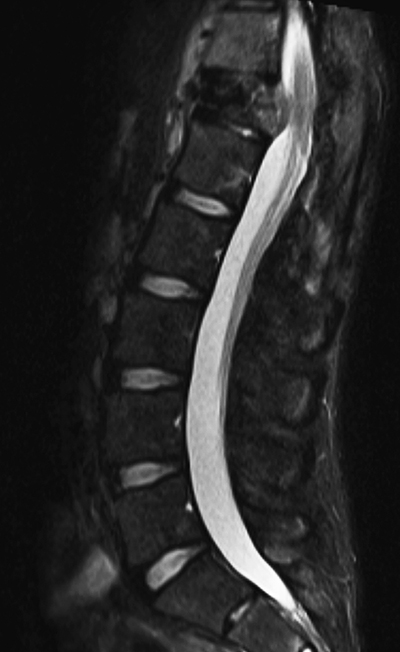 Radiation Sarcoma Figure 5