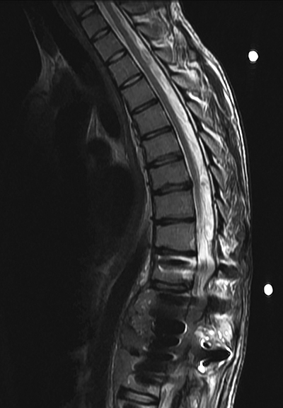 Radiation Sarcoma Figure 6