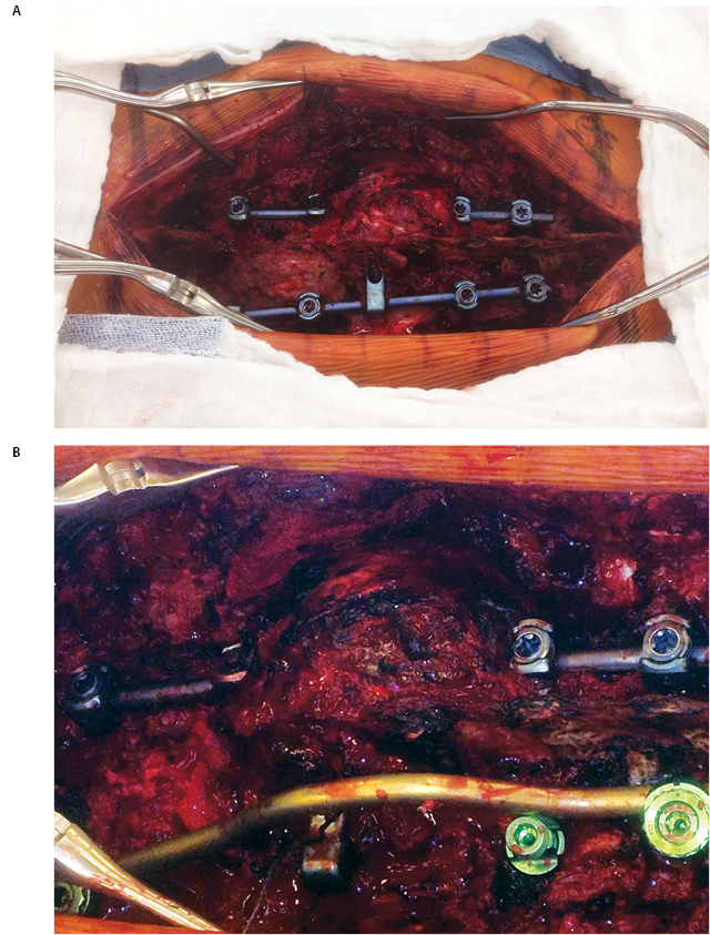 Radiation Sarcoma Figure 7