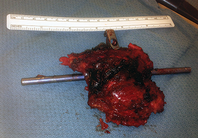 Radiation Sarcoma Figure 8