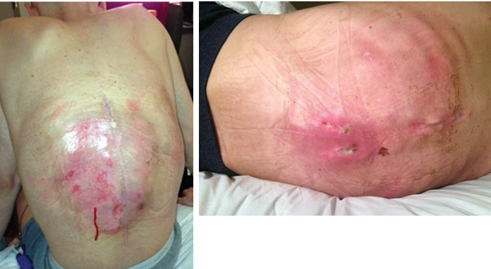 Radiation Sarcoma Figure 9