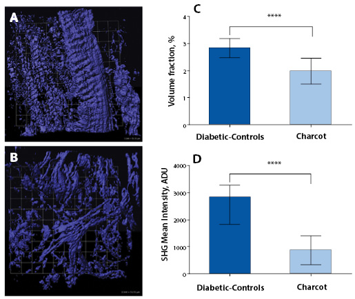 Charcot Neuroarthropathy Figure 2